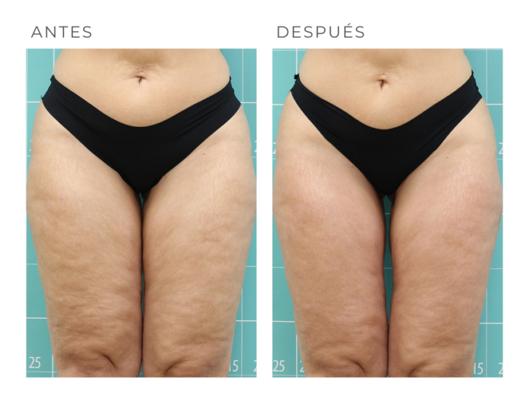 TERMOSALUD_ANTESYDESPUES (2)