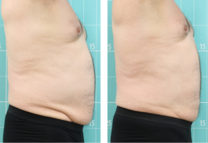 TERMOSALUD_ANTESYDESPUES (4)