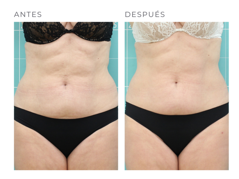 TERMOSALUD_ANTESYDESPUES